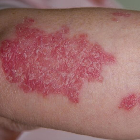 Psoriasis